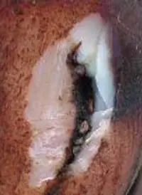 Beyaz Çizgi Hastalığı