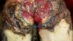 Digital Dermatitis