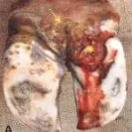 Erosio Ungulea