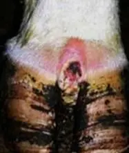 Interdigital Dermatitis