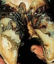 Interdigital Dermatitis