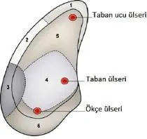 Ökçe Ülseri