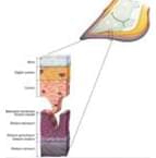 Pododermatitis Aseptika Circumcripta