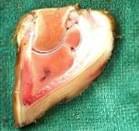 Pododermatitis Aseptika Circumcripta