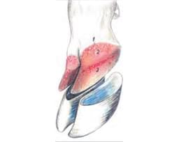 Pododermatitis Aseptika Diffuza