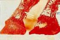 Pododermatitis Aseptika Diffuza