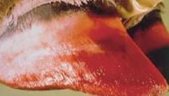 Pododermatitis Aseptika Diffuza