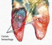 Pododermatitis Purulenta Superficialis