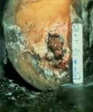 Taban Ucu Ülseri