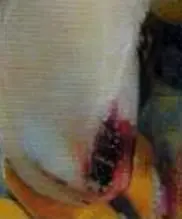 Taban Ucu Ülseri