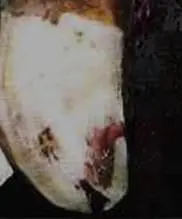 Taban Ucu Ülseri
