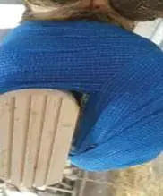 Taban Ucu Ülseri