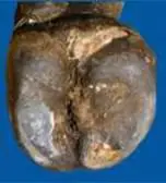 Taban Ucu Ülseri