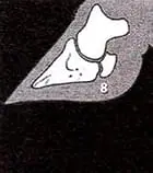 Taban Ucu Ülseri