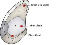 Taban Ülseri