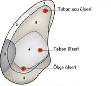Taban Ülseri