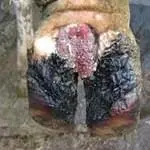 Verrikoz Dermatitis