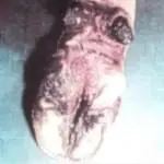 Verrikoz Dermatitis